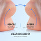 Electric Foot Callus Remover