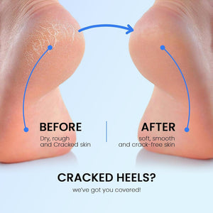 Electric Foot Callus Remover